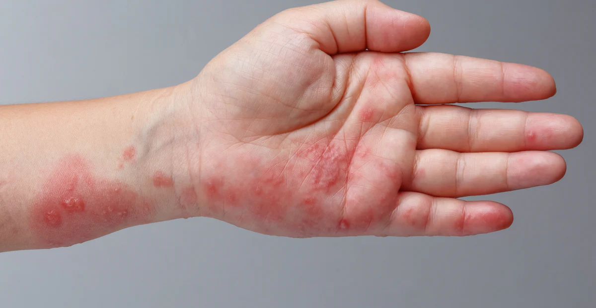 Heat_Rash_in_Adults_Causes_Symptoms_and_Effective_Treatments_1200x1200_crop_center